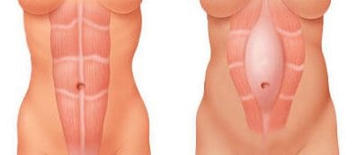 Diástasis Abdominal