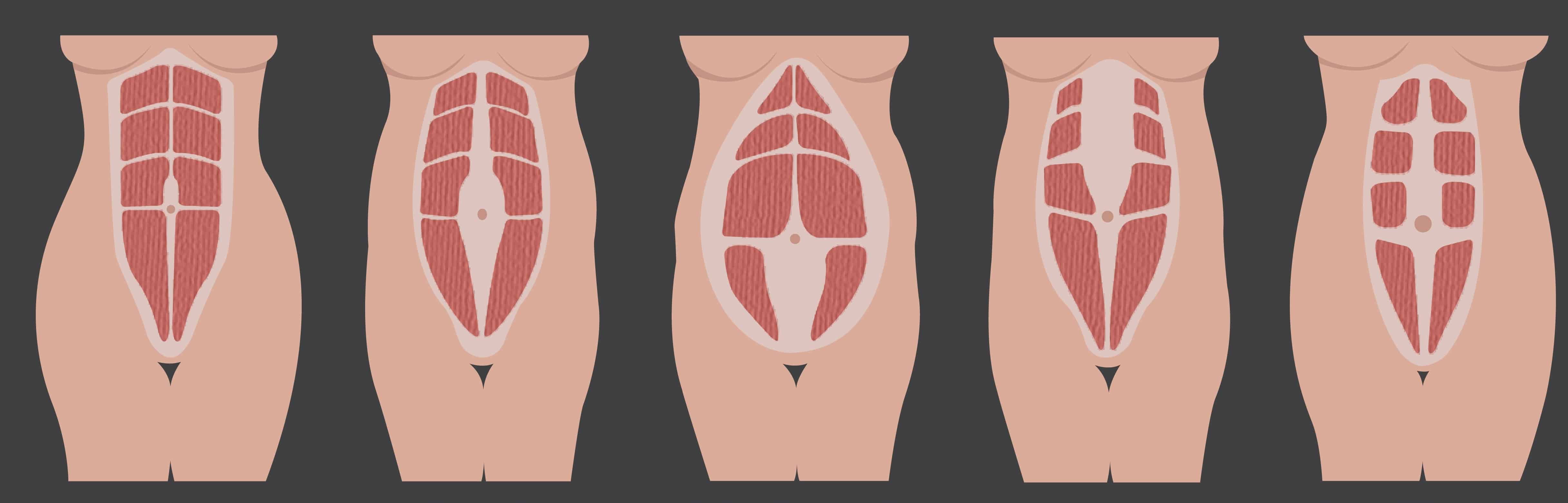 Diastasis Abdominal  II